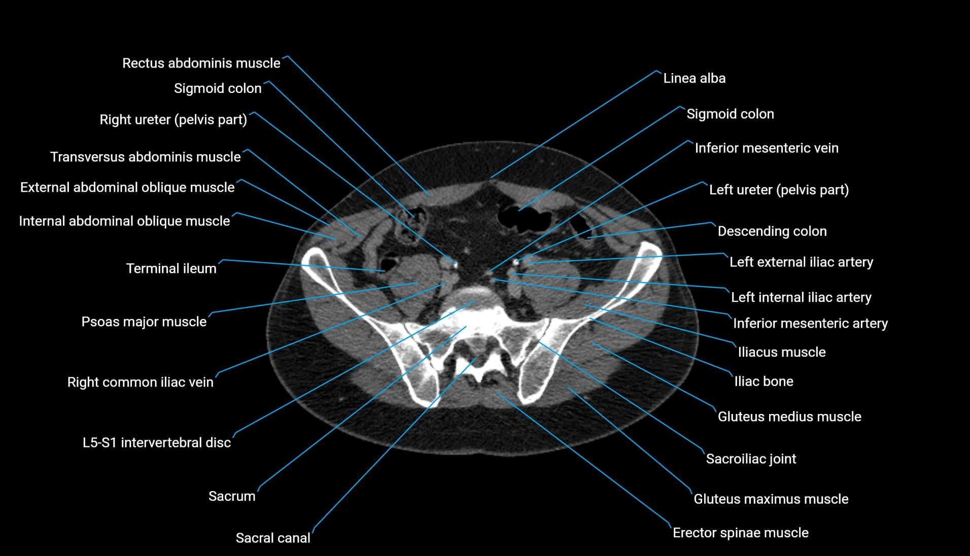 CT urogram axial cross sectional anatomy  labelled radiology image-00182.webp